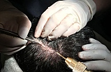 PRP destekli saç ekiminde PRP aşısının etkileri