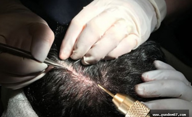 PRP destekli saç ekiminde PRP aşısının etkileri